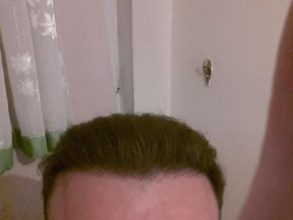 hair-transplant-turkey-blog (10)