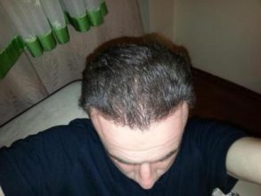 hair-transplant-turkey-blog (11)
