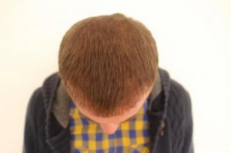 hair-transplant-turkey-blog (12)