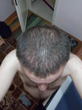 hair-transplant-turkey-blog (13)