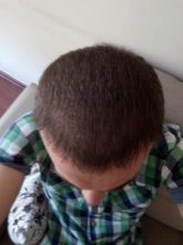 hair-transplant-turkey-blog (14)