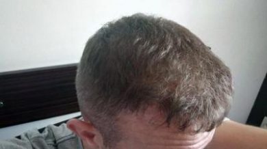 hair-transplant-turkey-blog (15)