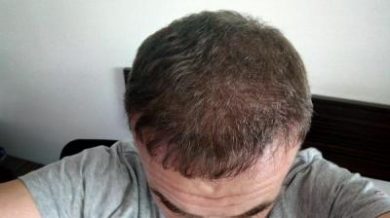 hair-transplant-turkey-blog (2)