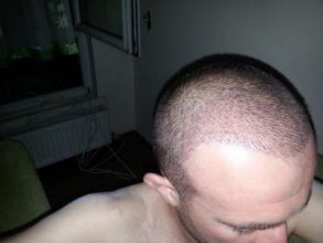 hair-transplant-turkey-blog (4)