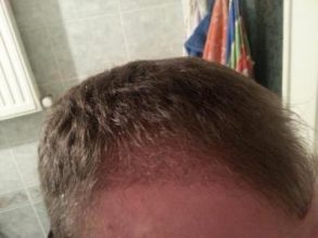 hair-transplant-turkey-blog (5)