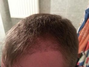 hair-transplant-turkey-blog (6)