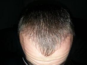 hair-transplant-turkey-blog (8)