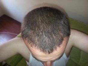 hair-transplant-turkey-blog (9)