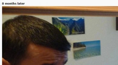 hair-transplant-turkey-cost (1)