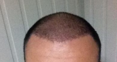 hair-transplant-turkey-cost (10)