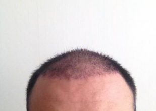 hair-transplant-turkey-cost (11)