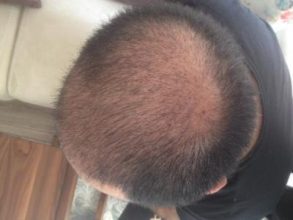 hair-transplant-turkey-cost (12)