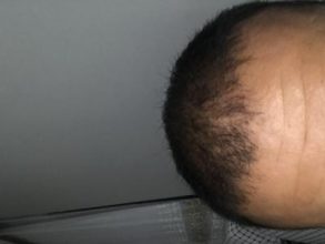 hair-transplant-turkey-cost (13)