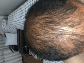 hair-transplant-turkey-cost (14)