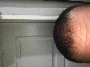 hair-transplant-turkey-cost (15)