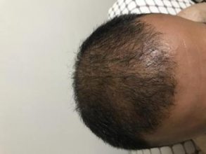 hair-transplant-turkey-cost (16)
