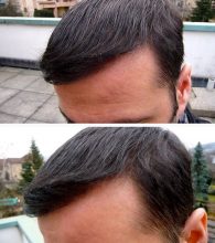 hair-transplant-turkey-cost (2)