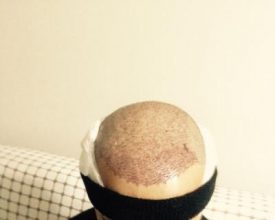 hair-transplant-turkey-cost (3)