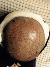 hair-transplant-turkey-cost (4)