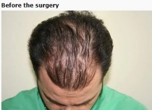hair-transplant-turkey-cost (4)