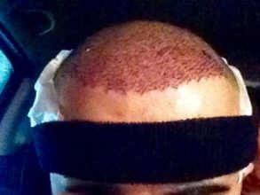 hair-transplant-turkey-cost (5)