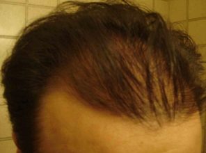 hair-transplant-turkey-cost (5)