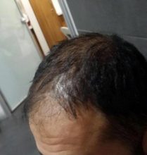 hair-transplant-turkey-cost (6)