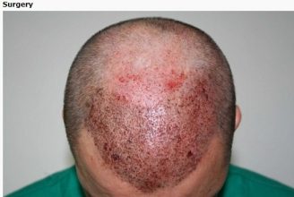 hair-transplant-turkey-cost (6)
