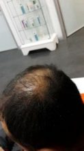 hair-transplant-turkey-cost (7)