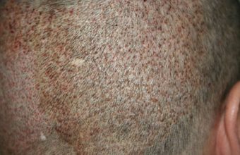 hair-transplant-turkey-cost (7)