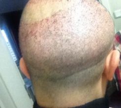 hair-transplant-turkey-cost (8)