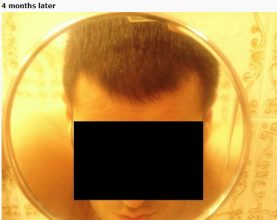 hair-transplant-turkey-cost (8)