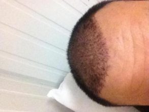 hair-transplant-turkey-cost (9)