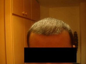 hair-transplant-turkey-cost (9)