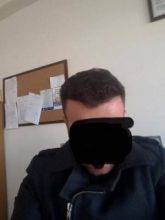 hair transplant turkey costs (13)