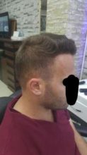 hair transplant turkey costs (15)