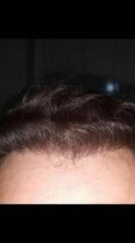 hair transplant turkey costs (16)
