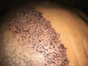 hair-transplant-turkey-forum (1)