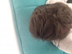 hair-transplant-turkey-forum (2)