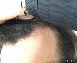 hair-transplant-turkey-istanbul (1)