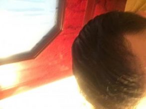 hair-transplant-turkey-istanbul (2)