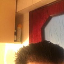 hair-transplant-turkey-istanbul (4)