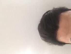 hair-transplant-turkey-istanbul (5)