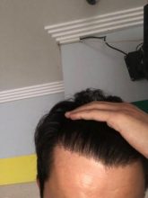 hair-transplant-turkey-package (1)