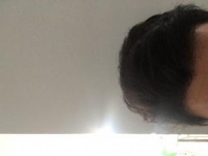 hair-transplant-turkey-package (2)