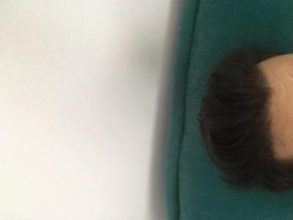 hair-transplant-turkey-package (3)