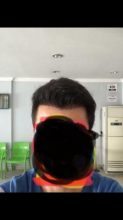 hair-transplant-turkey-package (4)