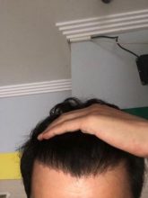 hair-transplant-turkey-reddit (1)