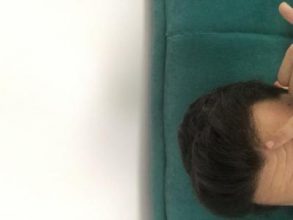 hair-transplant-turkey-reddit (2)
