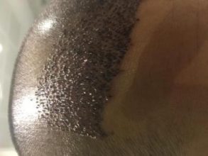 hair-transplant-turkey-reddit (3)